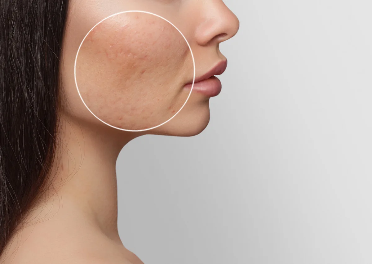Professionelle Aknebehandlung bei MediBeauty St. Gallen
